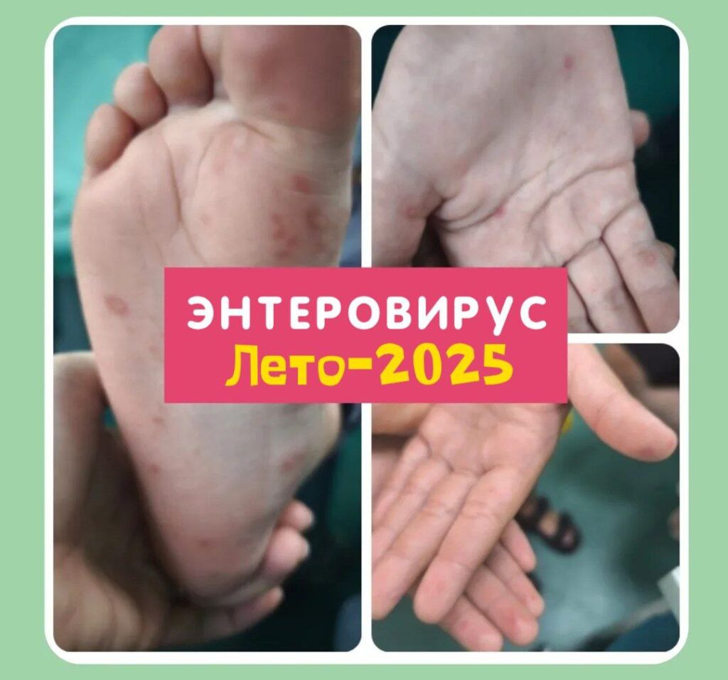 энтеровирус